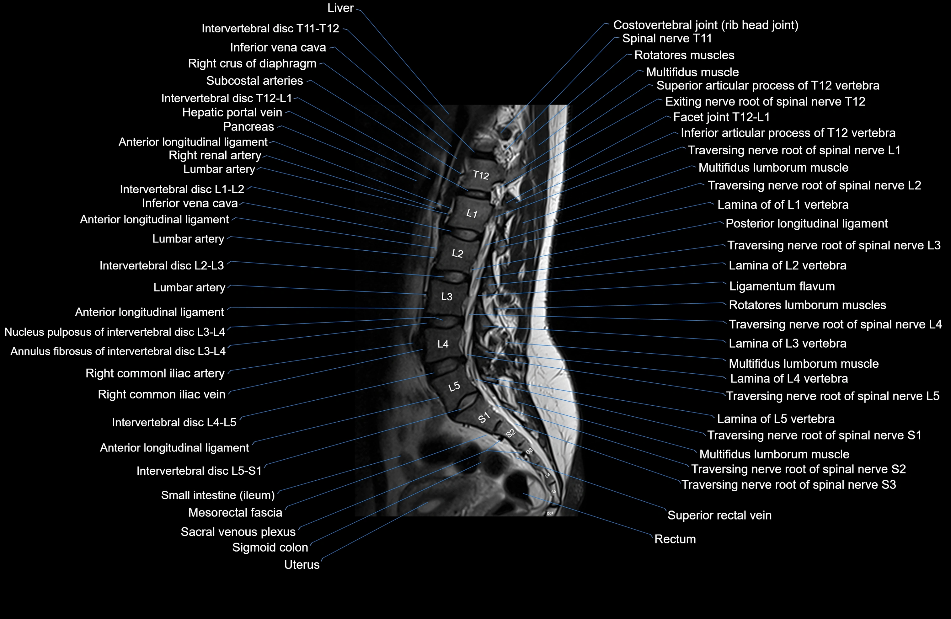 MRI lumbar spine sagittal cross sectional anatomy 3T radiology  image-img-00001-00010.webp